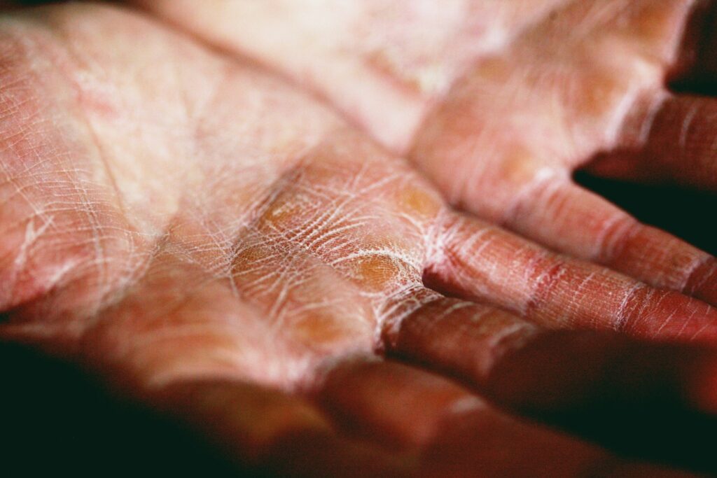 virgin coconut oil, organic coconut oil, skin, eczema